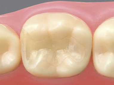 綾瀬亀有ロハス歯科＆矯正歯科でコンポジットレジン