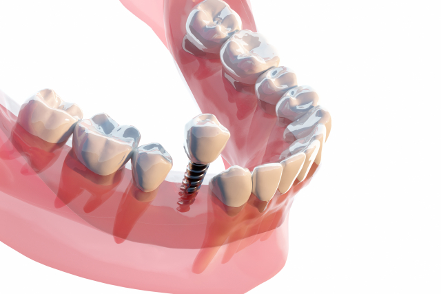 綾瀬亀有ロハス歯科＆矯正歯科のインプラント治療