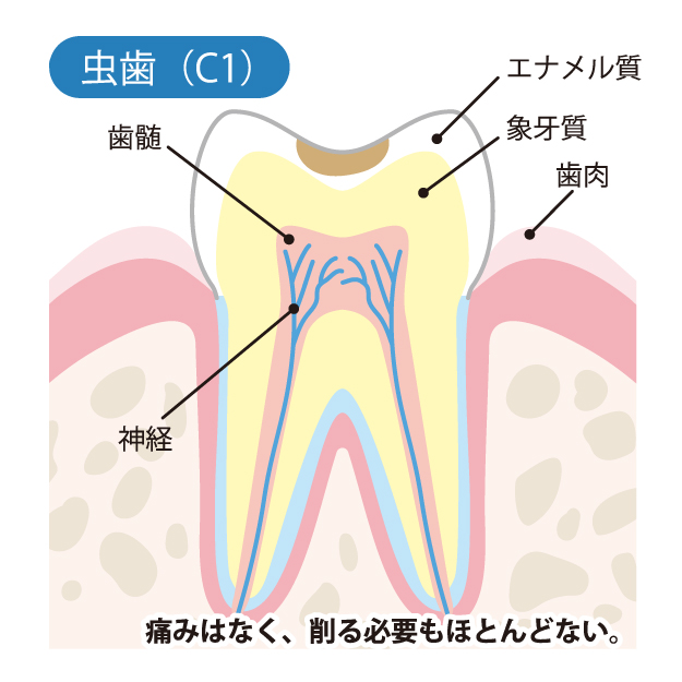 綾瀬亀有ロハス歯科＆矯正歯科で虫歯治療