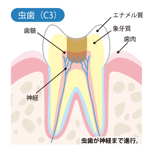 綾瀬亀有ロハス歯科＆矯正歯科で虫歯治療