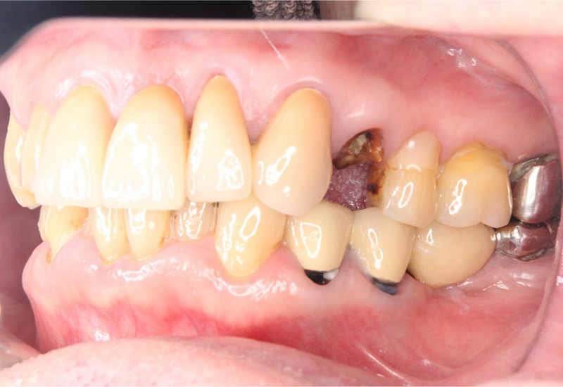 綾瀬亀有ロハス歯科＆矯正歯科のインプラント治療例