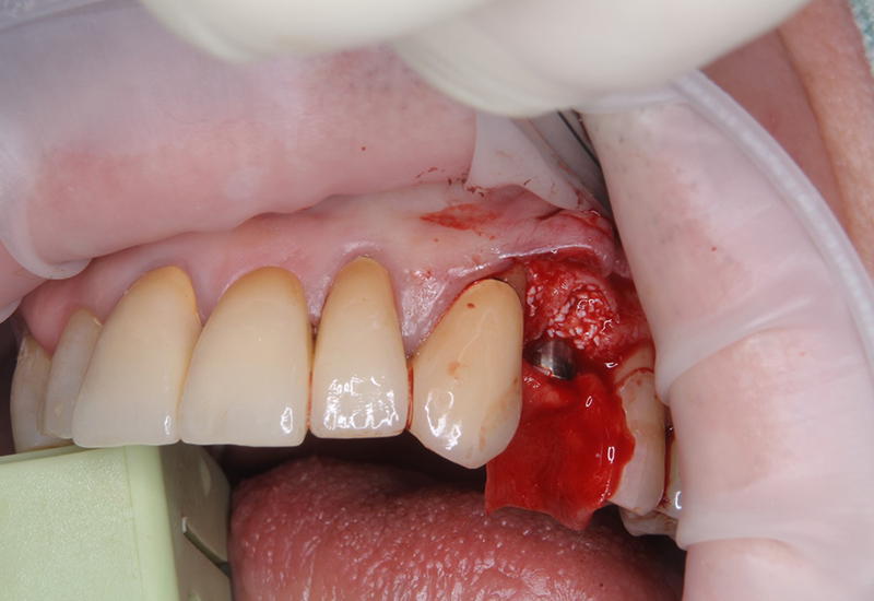 綾瀬亀有ロハス歯科＆矯正歯科のインプラント治療例