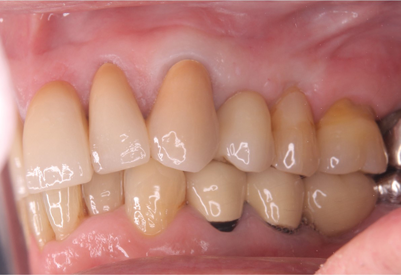 綾瀬亀有ロハス歯科＆矯正歯科のインプラント治療例