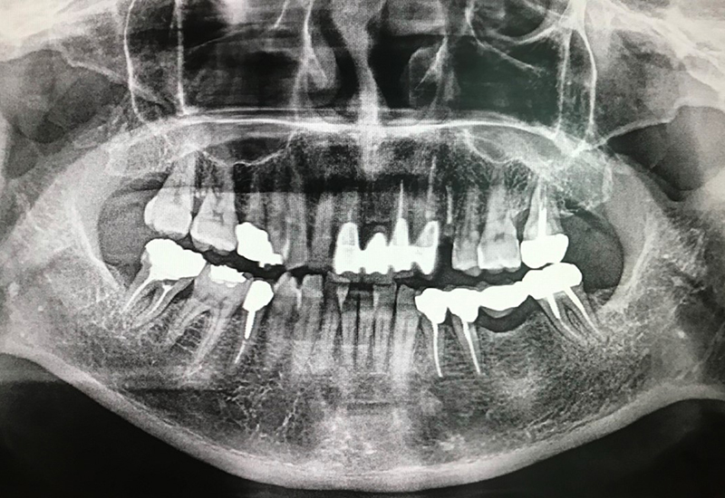 綾瀬亀有ロハス歯科＆矯正歯科のインプラント治療例