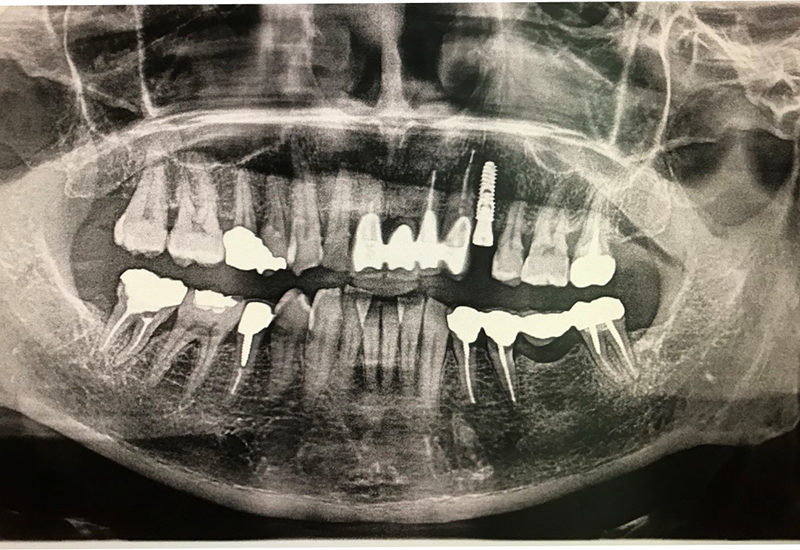 綾瀬亀有ロハス歯科＆矯正歯科のインプラント治療例