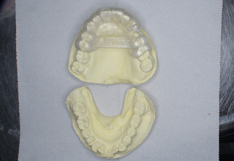 綾瀬亀有ロハス歯科＆矯正歯科のインプラント治療例