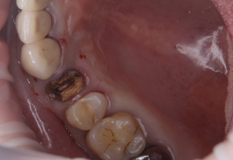 綾瀬亀有ロハス歯科＆矯正歯科のインプラント治療例
