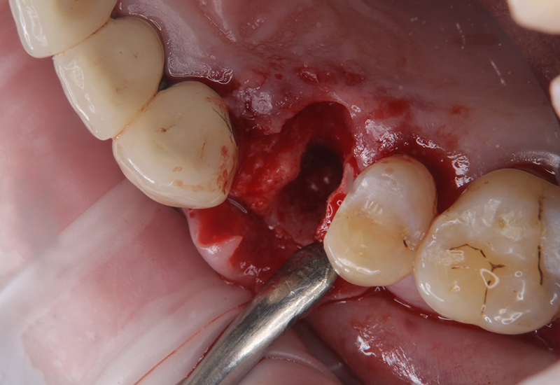 綾瀬亀有ロハス歯科＆矯正歯科のインプラント治療例