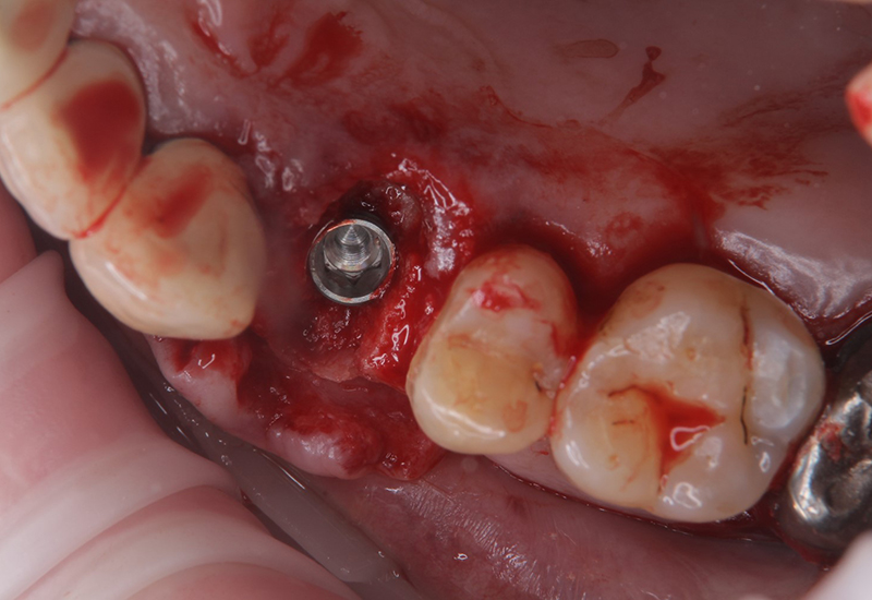 綾瀬亀有ロハス歯科＆矯正歯科のインプラント治療例