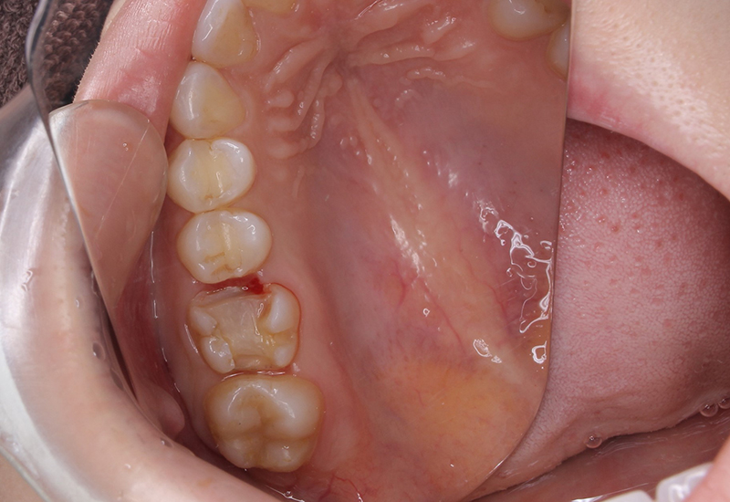 綾瀬亀有ロハス歯科＆矯正歯科のE-MAXインレー治療例