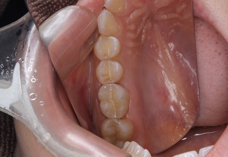 綾瀬亀有ロハス歯科＆矯正歯科のE-MAXインレー治療例