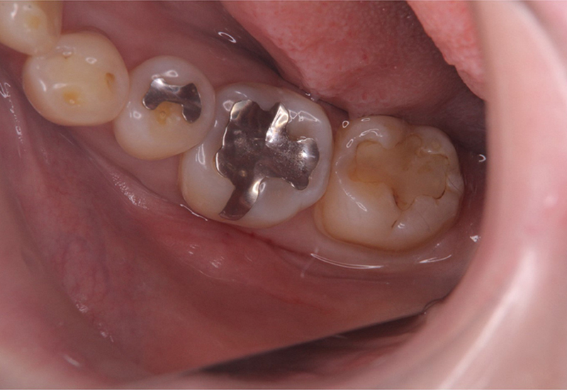 綾瀬亀有ロハス歯科＆矯正歯科の銀歯を白い歯に