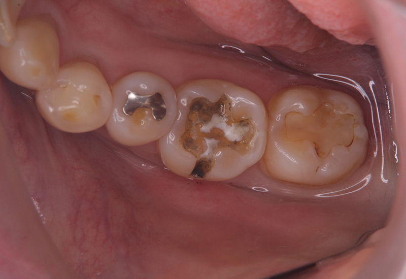 綾瀬亀有ロハス歯科＆矯正歯科の銀歯を白い歯に