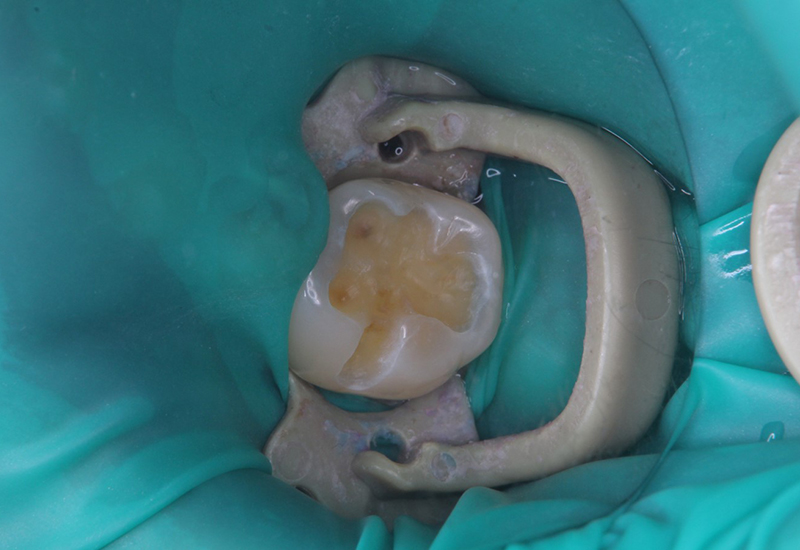 綾瀬亀有ロハス歯科＆矯正歯科の銀歯を白い歯に