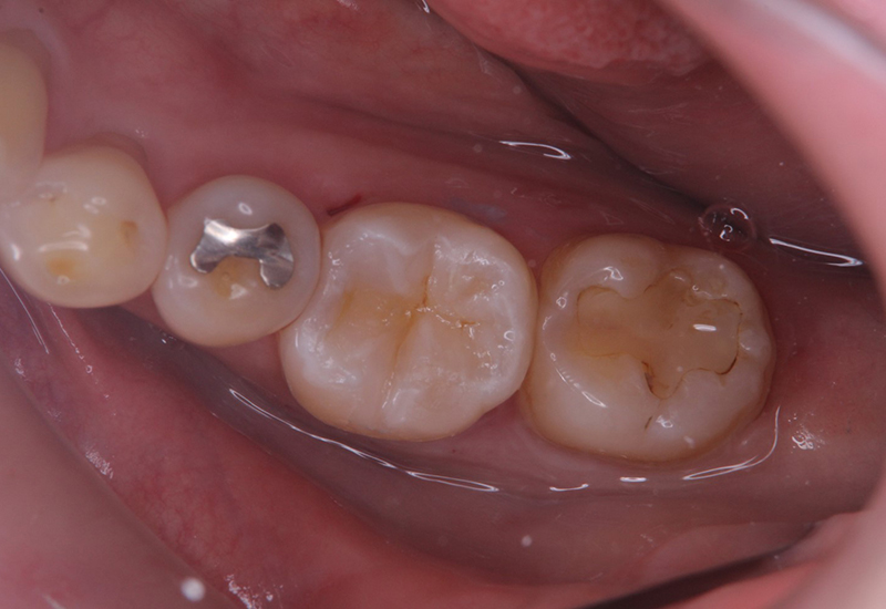 綾瀬亀有ロハス歯科＆矯正歯科の銀歯を白い歯に