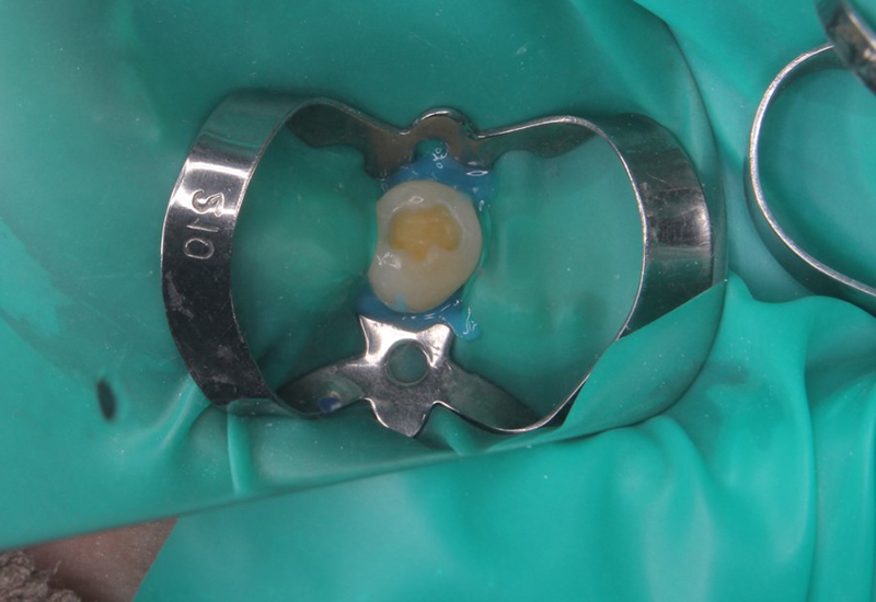 綾瀬亀有ロハス歯科＆矯正歯科の銀歯を白い歯に