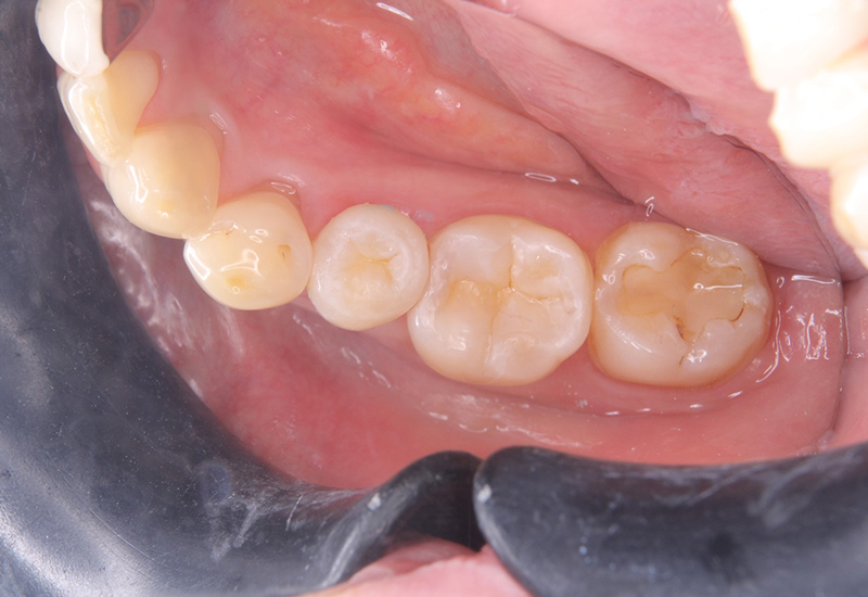 綾瀬亀有ロハス歯科＆矯正歯科の銀歯を白い歯に
