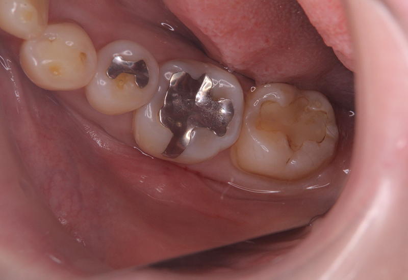 綾瀬亀有ロハス歯科＆矯正歯科の銀歯を白い歯に