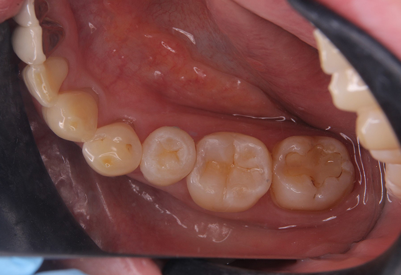 綾瀬亀有ロハス歯科＆矯正歯科の銀歯を白い歯に