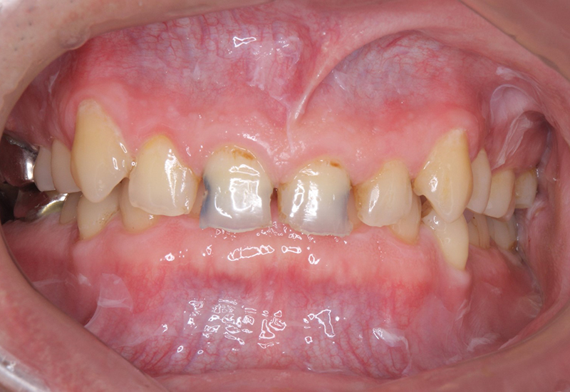 綾瀬亀有ロハス歯科＆矯正歯科のダイレクトボンディング治療例