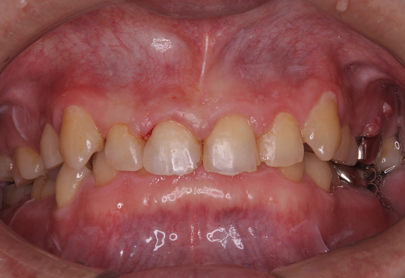 綾瀬亀有ロハス歯科＆矯正歯科のダイレクトボンディング治療例