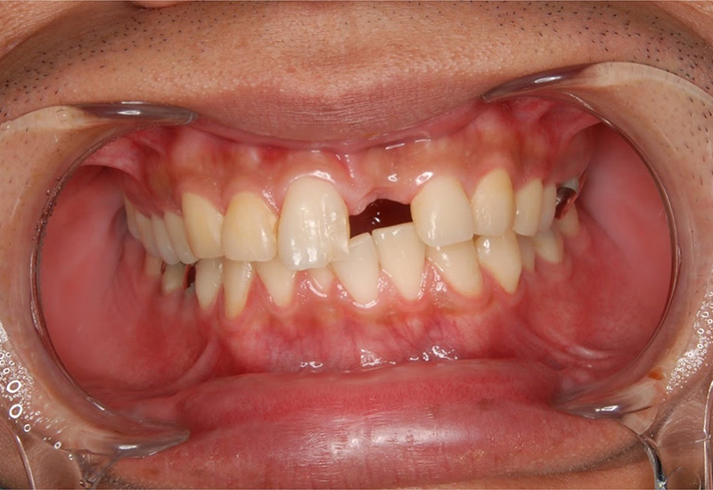 綾瀬亀有ロハス歯科＆矯正歯科のダイレクトボンディング治療例