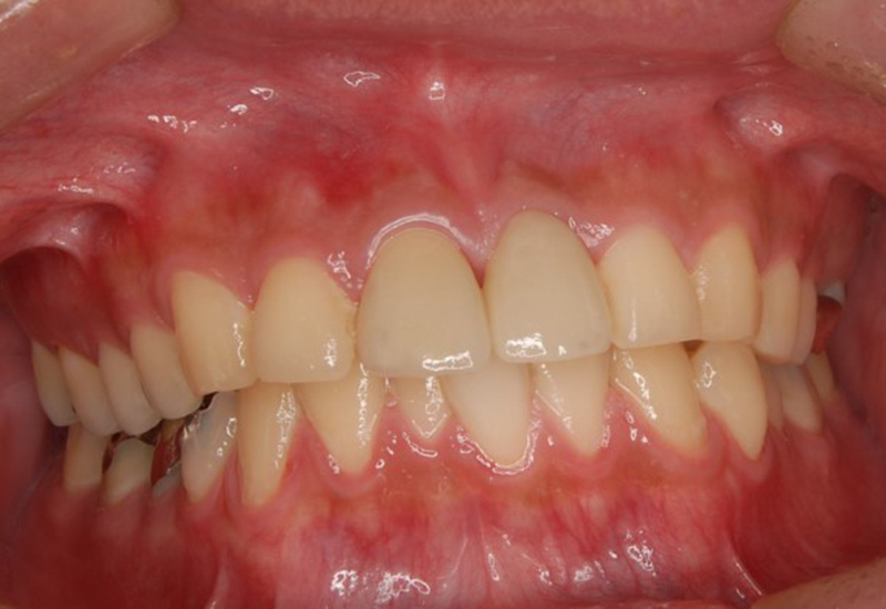 綾瀬亀有ロハス歯科&矯正歯科のインプラント治療例