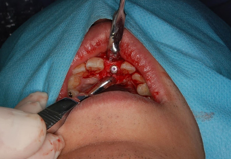 綾瀬亀有ロハス歯科&矯正歯科のインプラント治療例