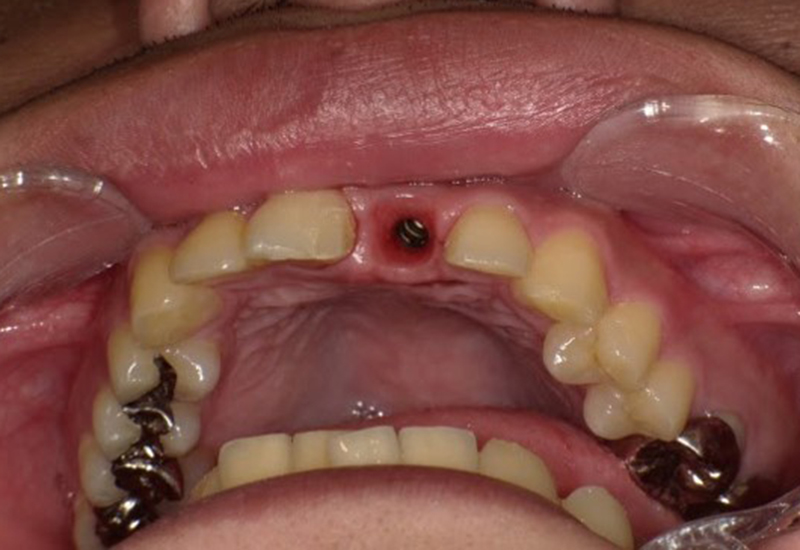 綾瀬亀有ロハス歯科&矯正歯科のインプラント治療例