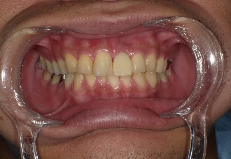 綾瀬亀有ロハス歯科&矯正歯科のインプラント治療例