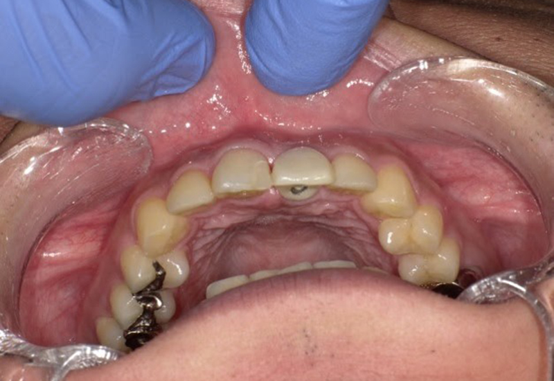綾瀬亀有ロハス歯科&矯正歯科のインプラント治療例