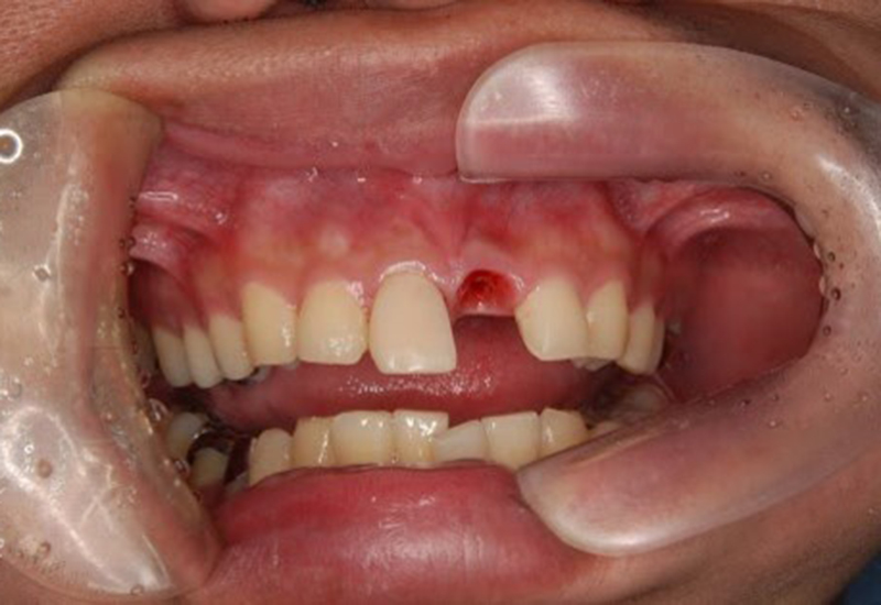 綾瀬亀有ロハス歯科&矯正歯科のインプラント治療例