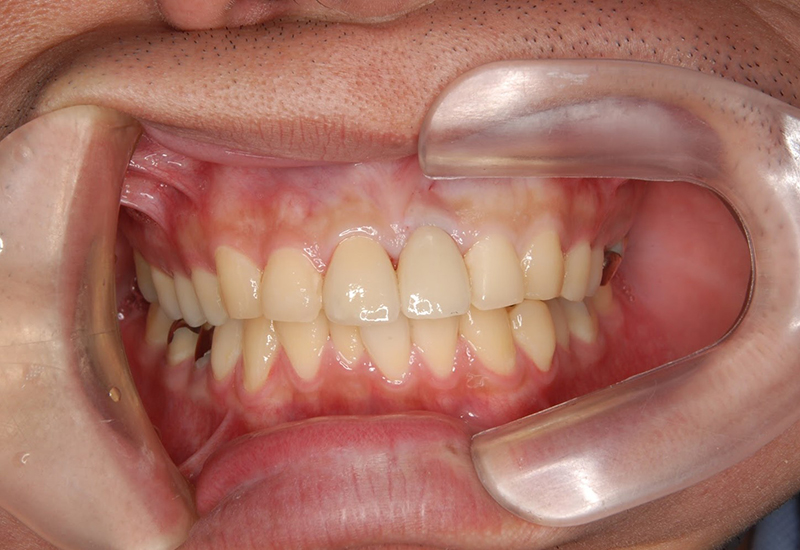 綾瀬亀有ロハス歯科&矯正歯科のインプラント治療例