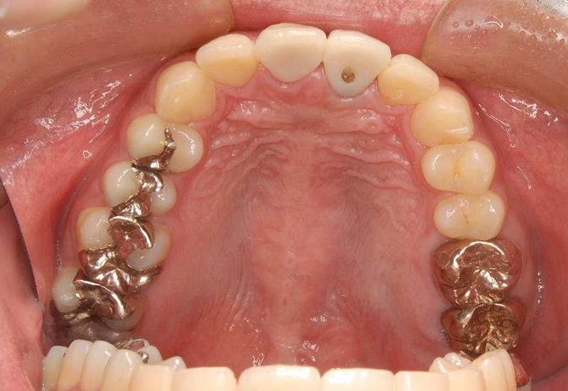 綾瀬亀有ロハス歯科&矯正歯科のインプラント治療例