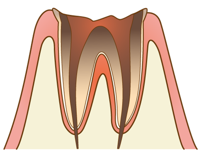 綾瀬亀有ロハス歯科＆矯正歯科のMI治療