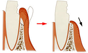 綾瀬亀有ロハス歯科＆矯正歯科の歯冠長延長術（クラウンレングスニング）
