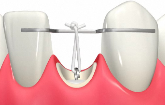 綾瀬亀有ロハス歯科＆矯正歯科の矯正的挺出（エキストルージョン）