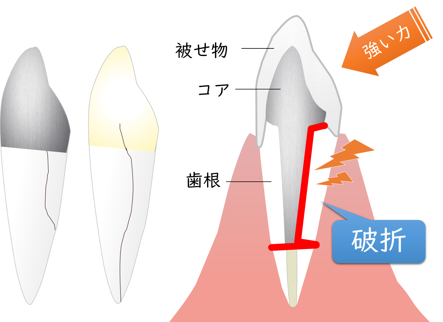 綾瀬亀有ロハス歯科＆矯正歯科の歯根破折の治療
