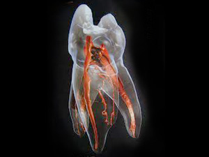 綾瀬亀有ロハス歯科＆矯正歯科の根管治療