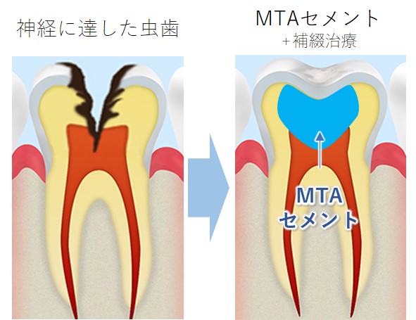 綾瀬亀有ロハス歯科＆矯正歯科のMTAセメント