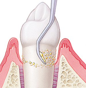 綾瀬亀有ロハス歯科＆矯正歯科の歯周病治療