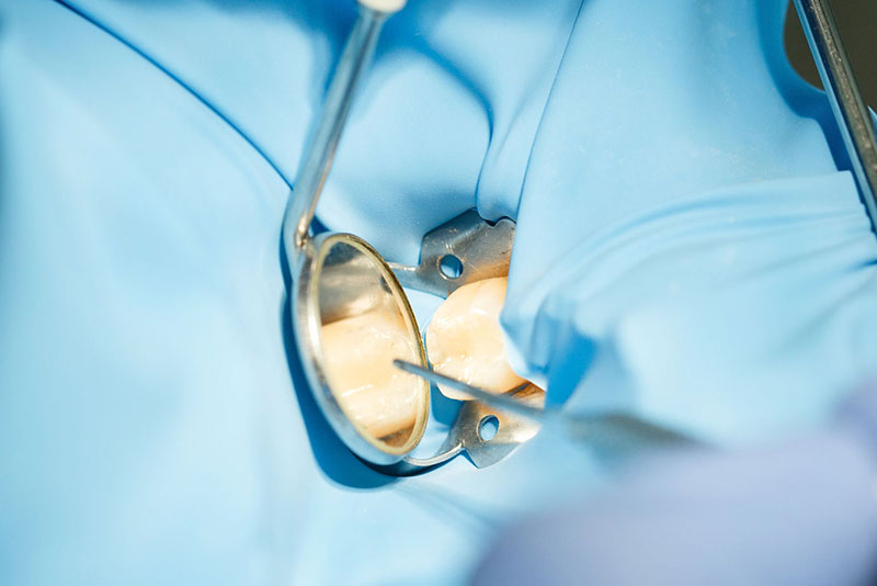 綾瀬亀有ロハス歯科＆矯正歯科でラバーダム