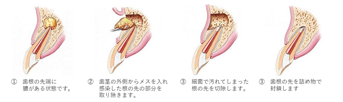 綾瀬亀有ロハス歯科＆矯正歯科で歯根端切除術