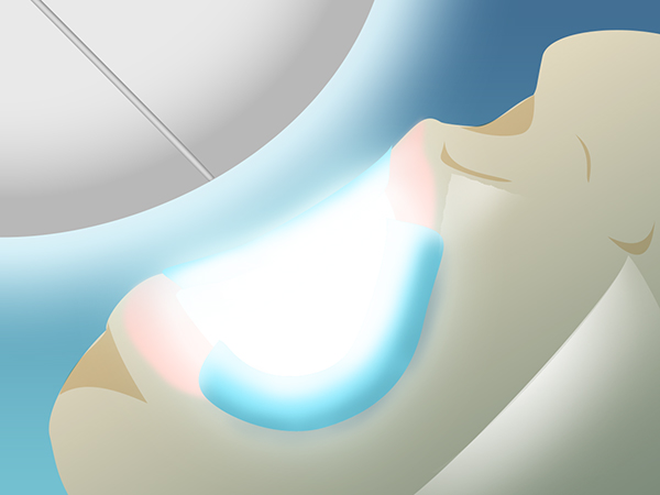 綾瀬亀有ロハス歯科＆矯正歯科でホワイトニング